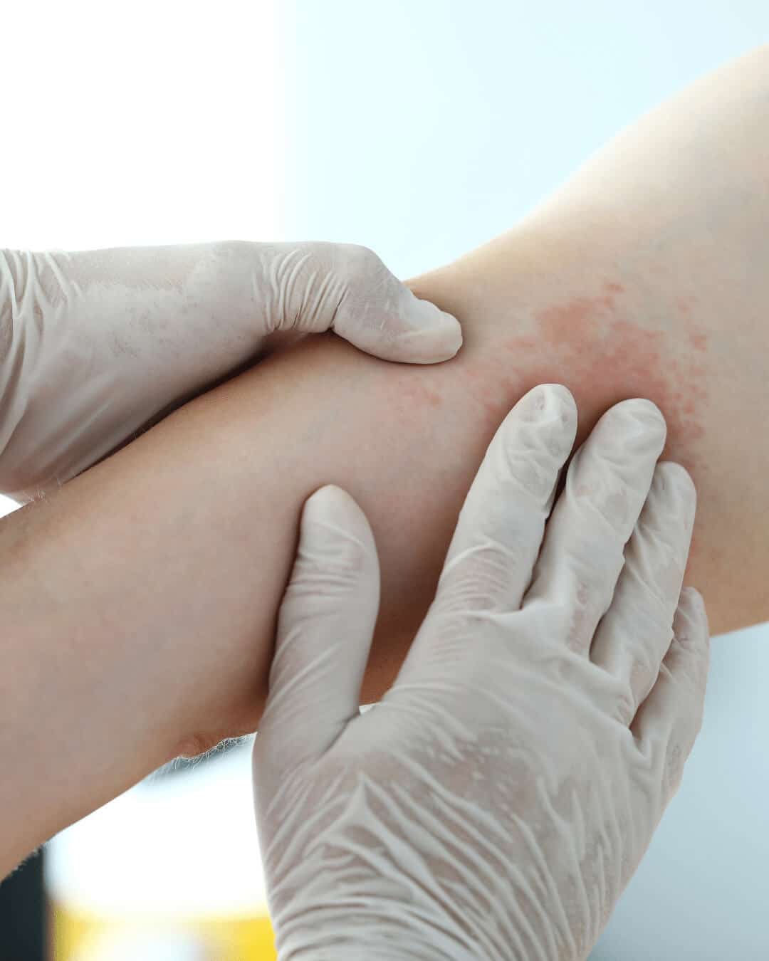 Brazo con eritema en la parte anterior del codo siendo examinado por dos manos con guantes quirúrgicos blancos